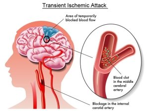 Transient-Ischemic-Attack